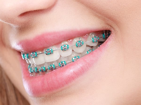 Braces Near Me